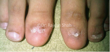 Long term treatment of nail Lichen Planus