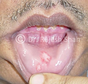 mouth-ulcer