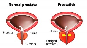 prostatitis