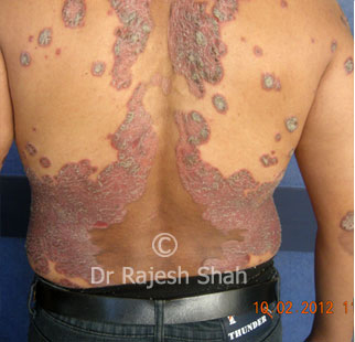 Psoriasis on back