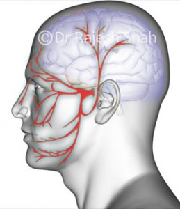 trigeminal_neuralgia