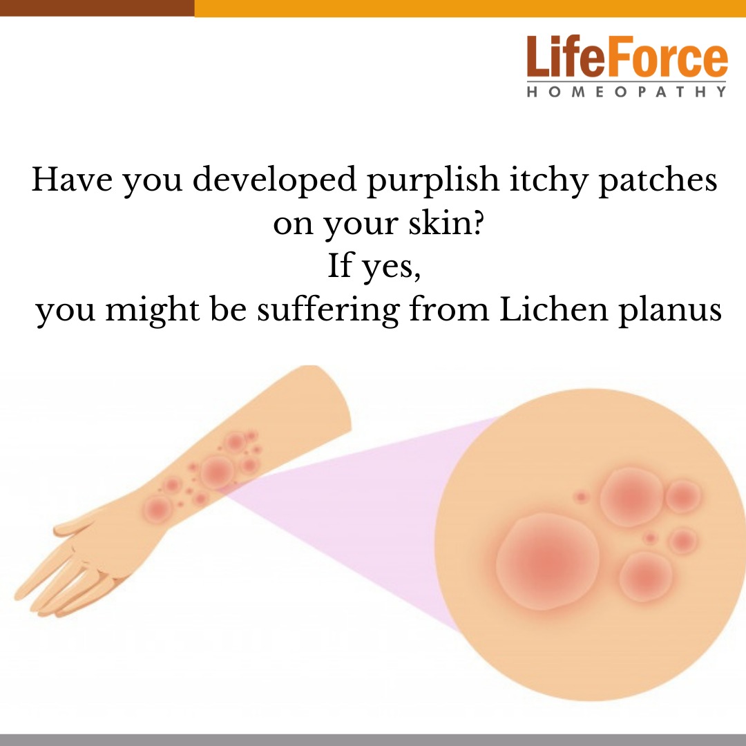 Homeopathy Treatment For Lichen Planus Safe And Effective Treatment