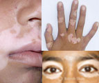 Vitiligo-affecting-mucocutaneous-thumb