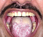 Oral Lichen Planus