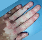 psoriasis-vitiligo