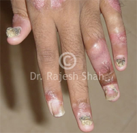 Psoriasis with Psoriatic arthritis