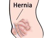 homeopathy cure for Hernia