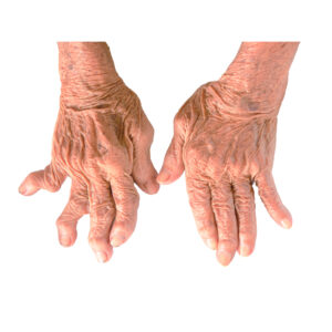 rheumatoid-arthritis