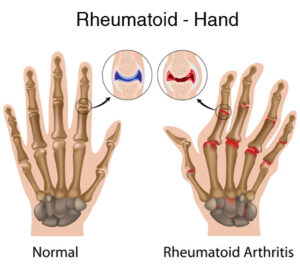 rheumatoid-arthritis