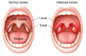 tonsillitis