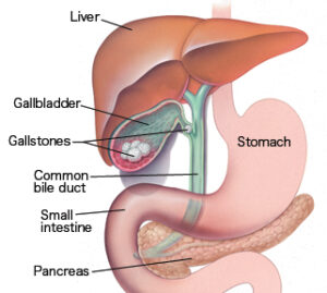 gallstones3