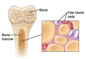 aplastic anaemia