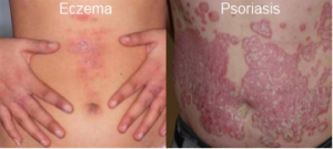 psoriasis