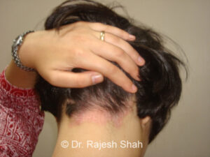 scalp_psoriasis_drshah