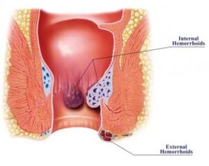 internal-and-external-hemorrhoids