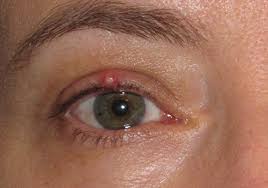 Chalazion