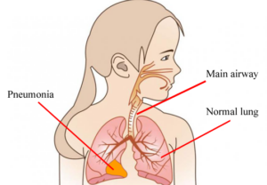 pneumonia