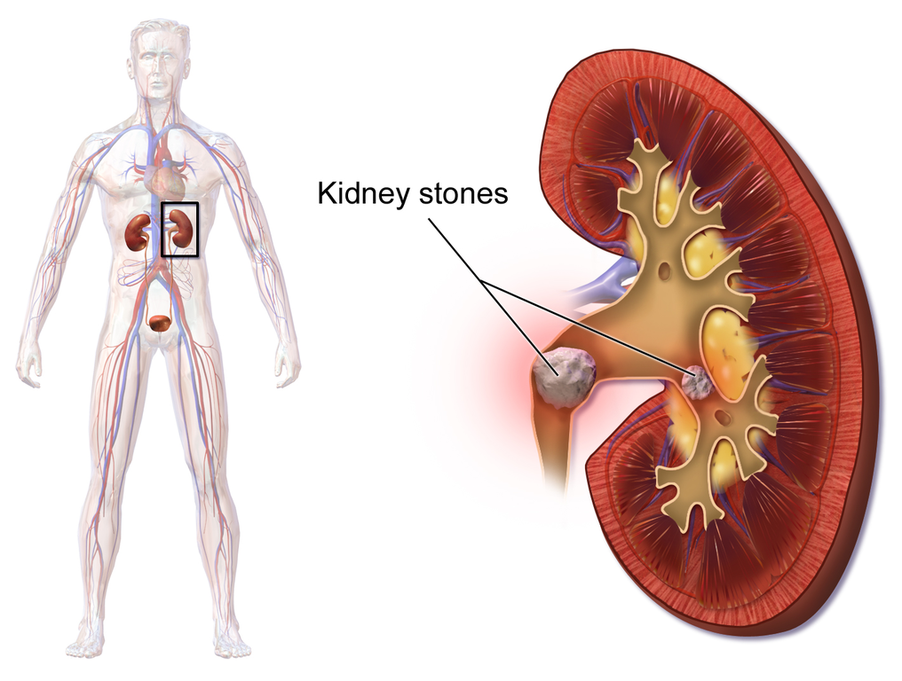 Kidney Stones Treatment