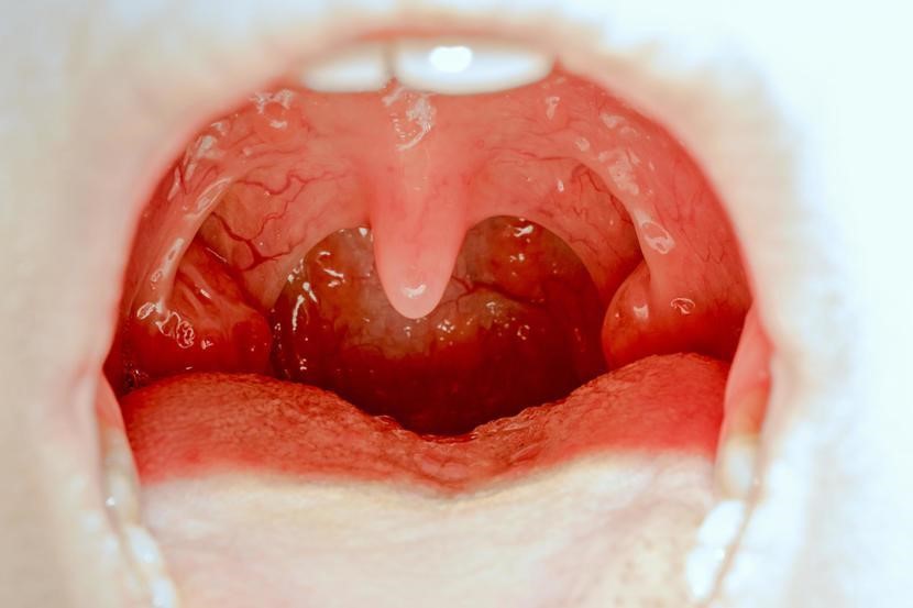 tonsilitis treatment