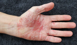 Psoriasis on hands