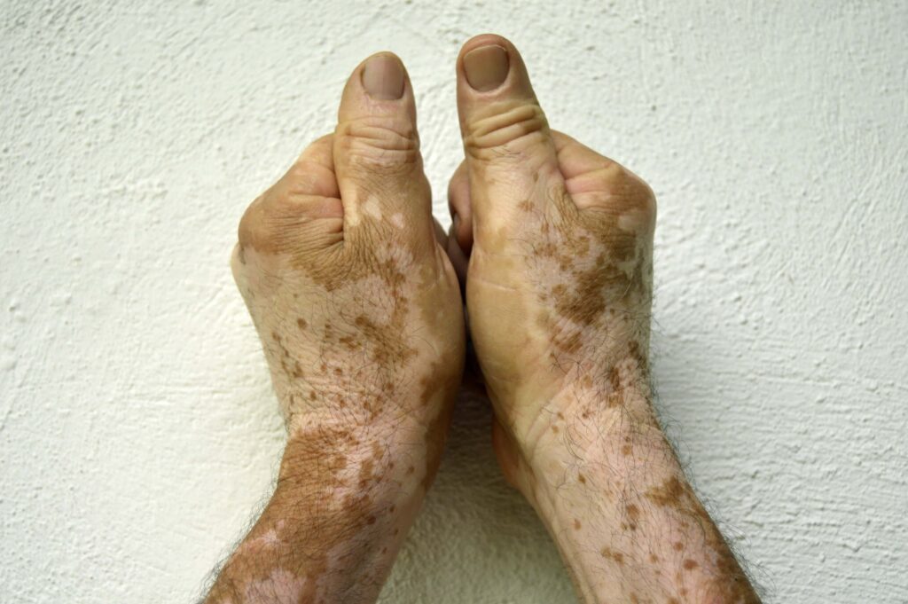 Vitiligo risk