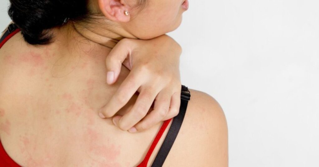 itchy back due to urticaria