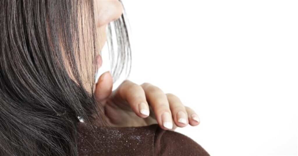 Woman suffering from dandruff