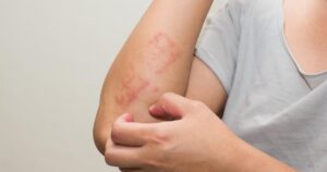 Painful itching due to Lichen Planus