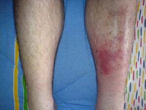 Signs of cellulitis