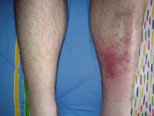 Signs of cellulitis