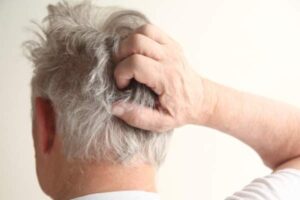 Dandruff or Scalp psoriasis