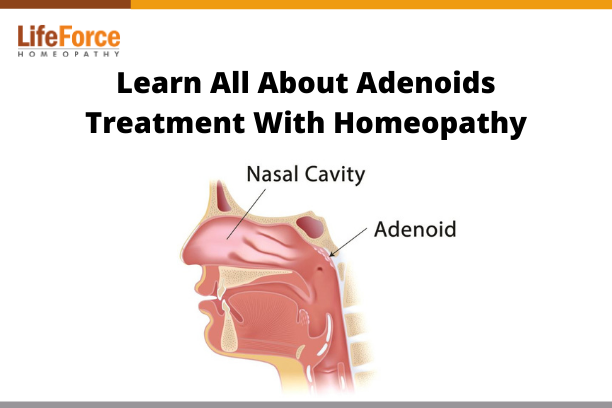 Adenoids treatment in homeopathy