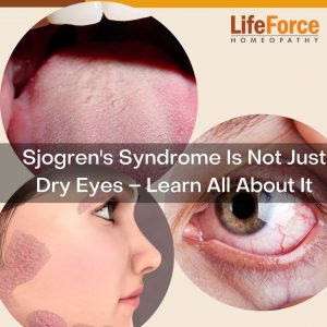 Sjogren's Syndrome