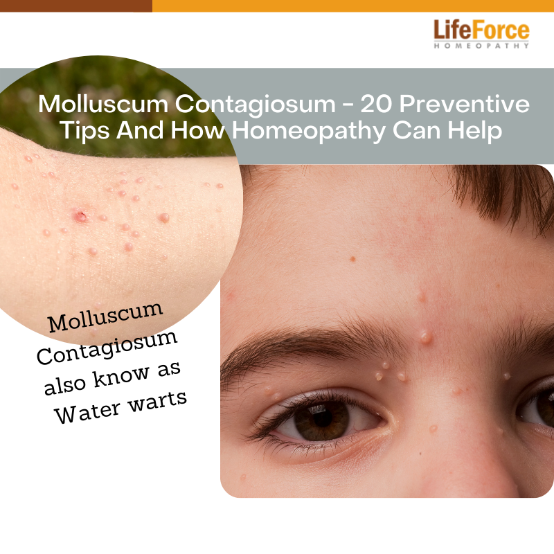 Homeopathy for Molluscum Contagiosum