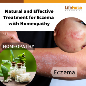 Treatment for Eczema with Homeopathy