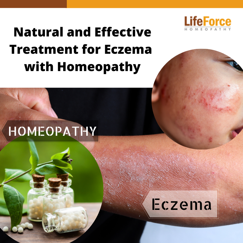 Treatment for Eczema with Homeopathy