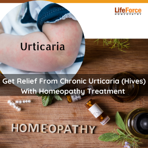 Get Relief From Chronic Urticaria (Hives) With Homeopathy Treatment | Know Symptoms of Hives