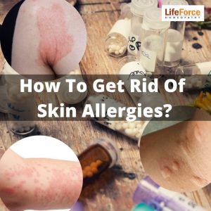 Skin Allergies