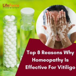 Homeopathy Treatment for Vitiligo