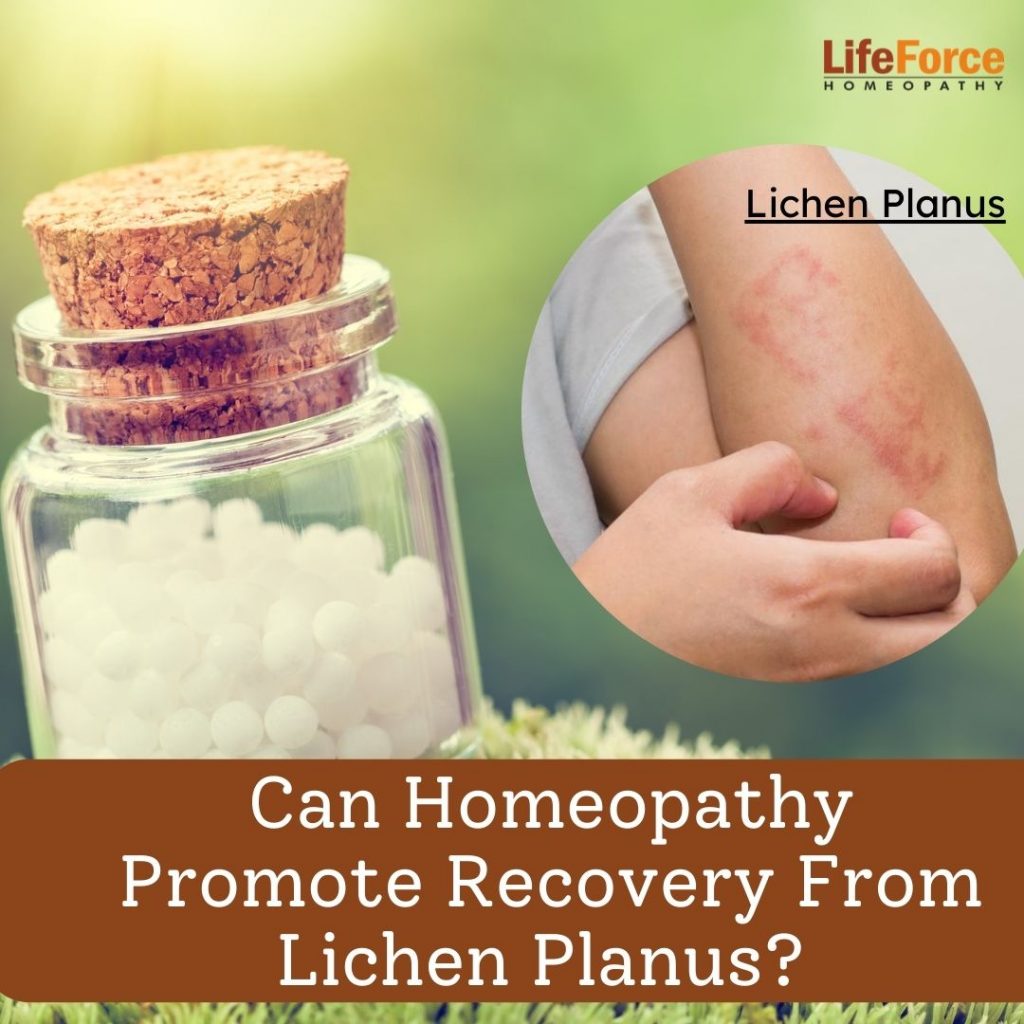 Lichen planus