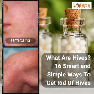 What Are Hives? 16 Smart and Simple Ways To Get Rid Of Hives