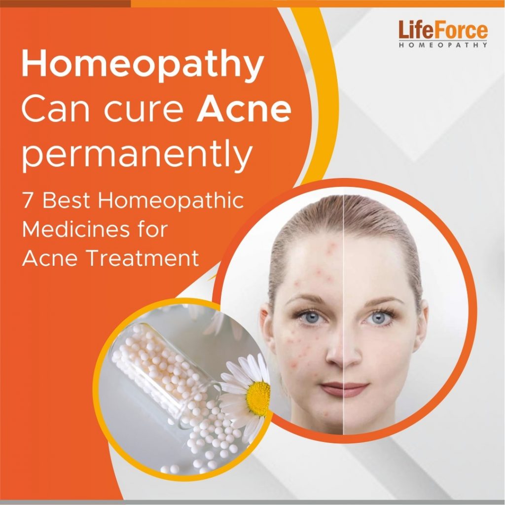 7 Best Homeopathic Medicines For Acne Treatment