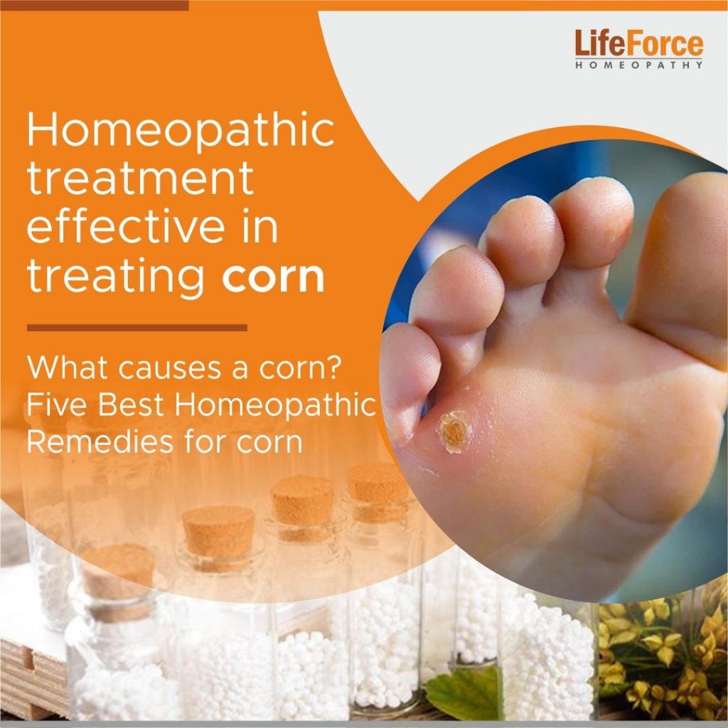 Homeopathic treatment effective in treating corn,