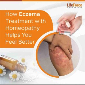 How Eczema Treatment with Homeopathy Helps You Feel Better