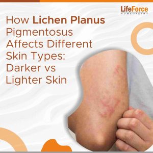 How Lichen Planus Pigmentosus Affects Different Skin Types: Darker vs Lighter Skin