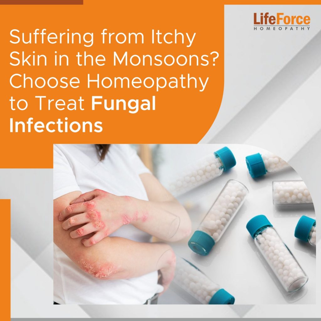 Suffering from Itchy Skin in the Monsoons? – Choose Homeopathy to Treat Fungal Infections