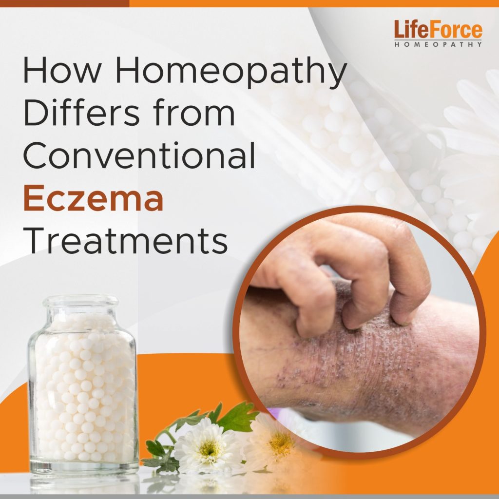 How Homeopathy Differs from Conventional Eczema Treatments