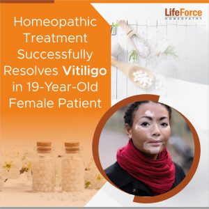 Homeopathic Treatment Successfully Resolves Vitiligo in 19-Year-Old Female Patient