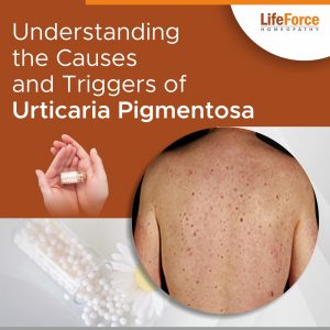 Understanding the Causes and Triggers of Urticaria Pigmentosa