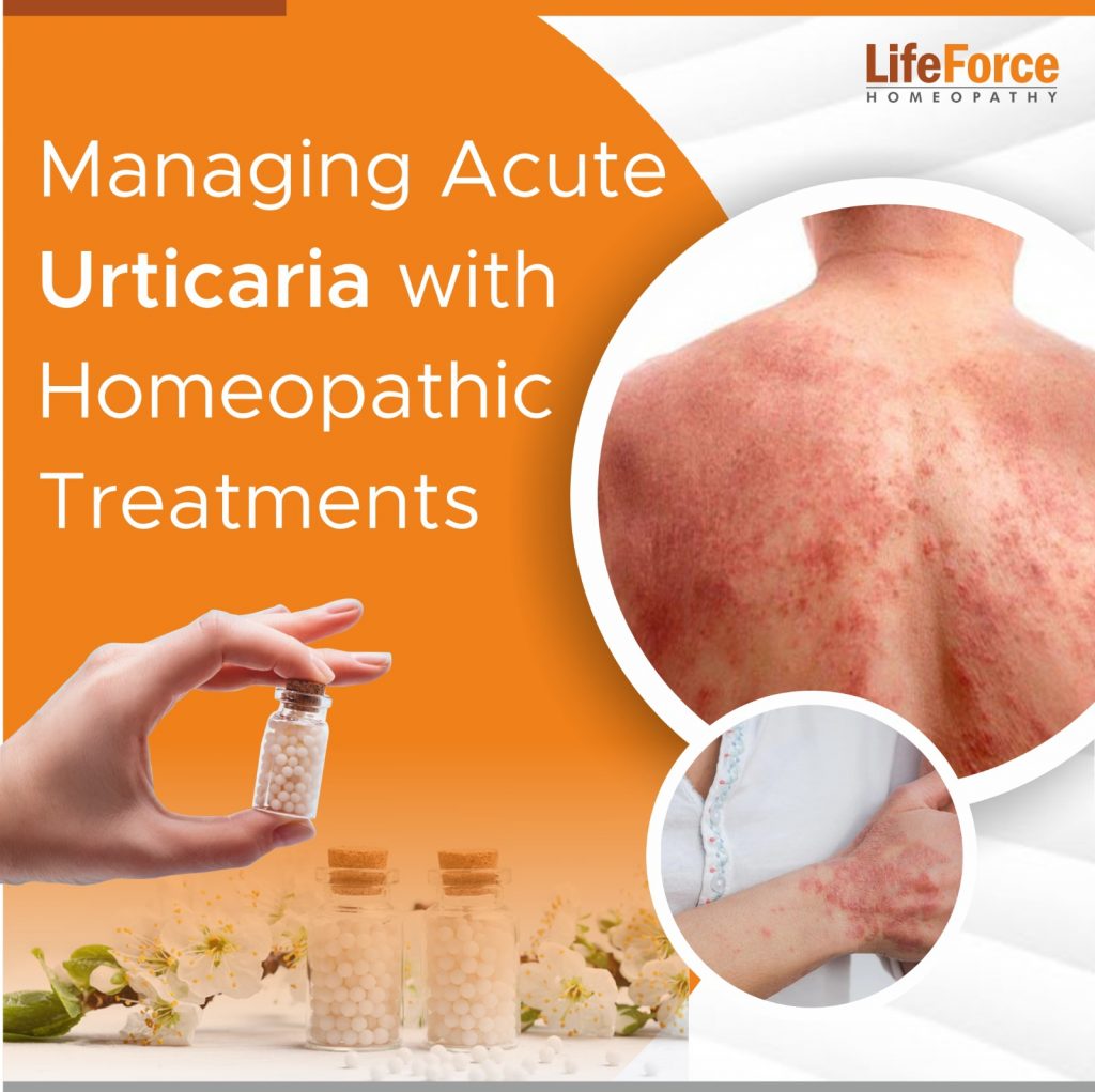 Managing Acute Urticaria with Homeopathic Treatments